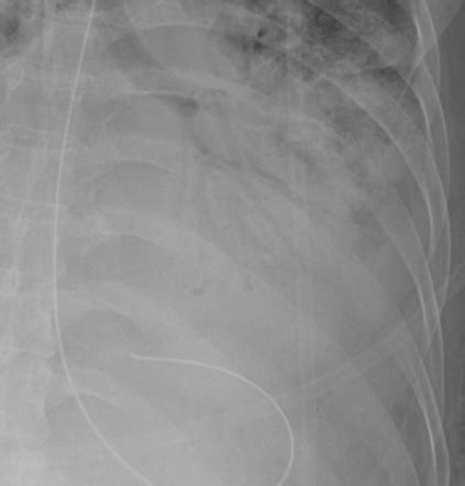 Air bronchogram | Radiology Case | Radiopaedia.org