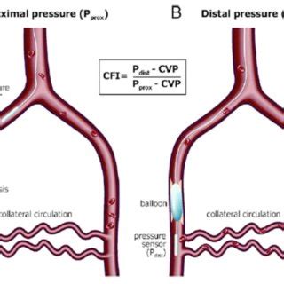 (PDF) Collateral Circulation in Chronic Total Occlusions - An Interventional Perspective