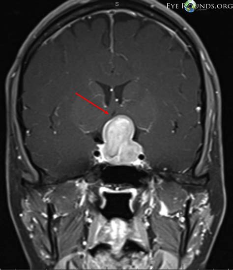 Post-contrast T1 brain MRI, coronal view, showing a pituitary adenoma with elevation and ...