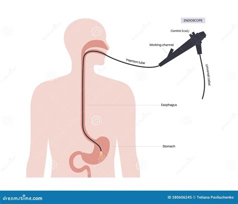 Gastroscopy Endoscopy Procedure Stock Vector - Illustration of human ...