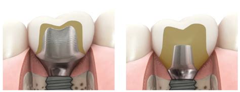 Prosthesis | Free Full-Text | Radiological and Periodontal Evaluation of Stock and Custom CAD ...