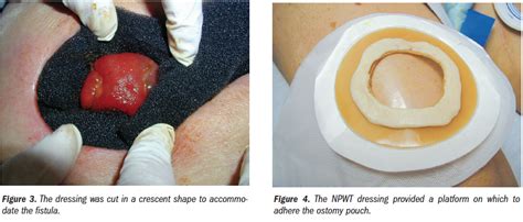 Colocutaneous Fistula Management in a Dehisced Wound: A Case Study