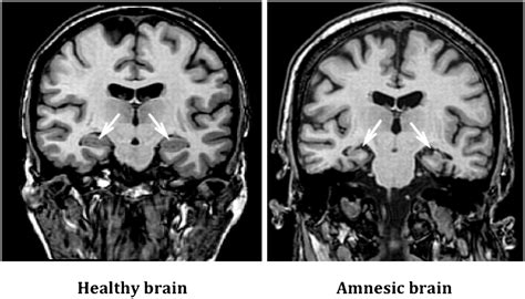 Amnesia : Causes, Symptoms, Diagnosis, Treatment, and Prevention