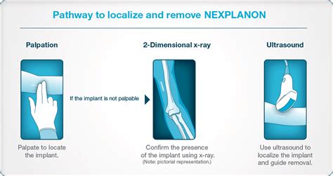 Insertion and Removal Instructions for NEXPLANON® (etonogestrel implant ...