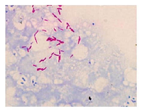 Examination of sputum with Mycobacterium tuberculosis (MTB) positive ...