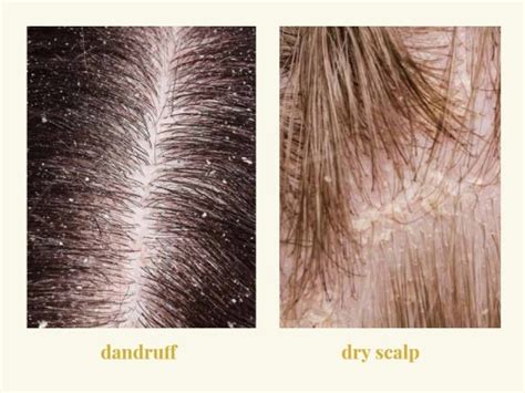 Dandruff vs. Dry Scalp: Causes, Symptoms, and Best Treatments