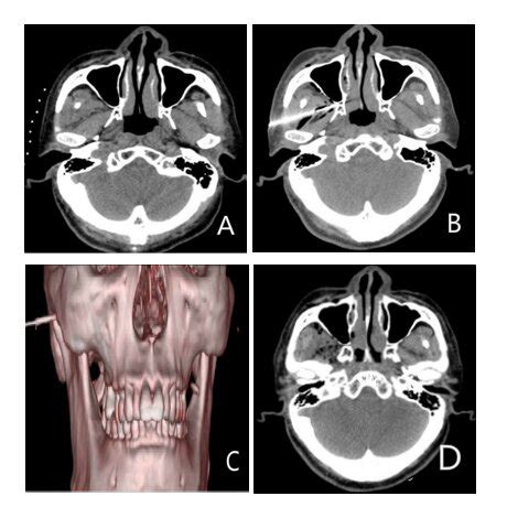 Left lateral rectus muscle palsy was noted immediately in the recovery... | Download Scientific ...