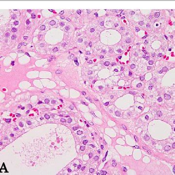 Histology of the thyroid gland. a Multiple follicular adenomas with a... | Download Scientific ...