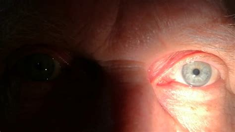 Afferent Pupillary Defect