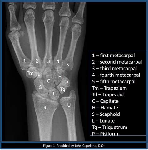 [Figure, Wrist x-ray with labeled osseous anatomy Contributed by John ...