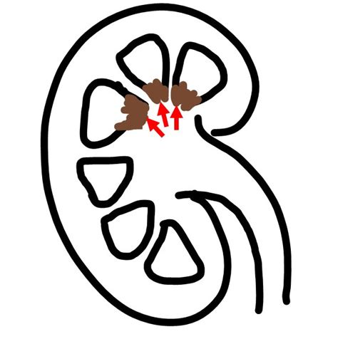 RENAL PAPILLARY NECROSIS - Pathology Made Simple