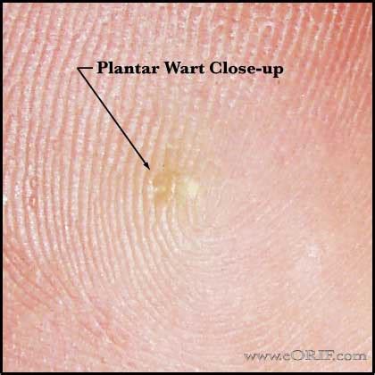 Plantar Wart Treatment Cpt Code | Bruin Blog