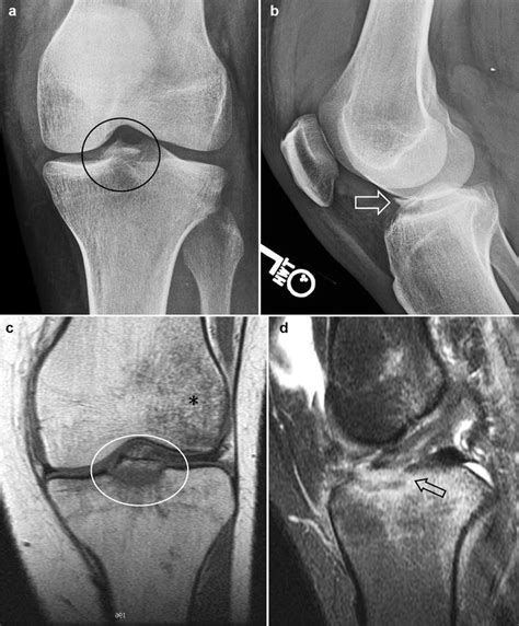 Anterior tibial eminence fracture. a Frontal radiograph shows a... | Download Scientific Diagram