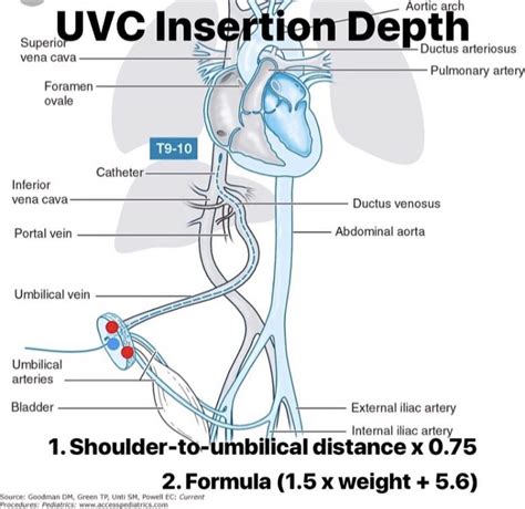 UVC insertion depth calculations. | Nicu nurse education, Nicu rn, Nicu ...