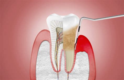 Periodontal therapy – Valleyview Dental