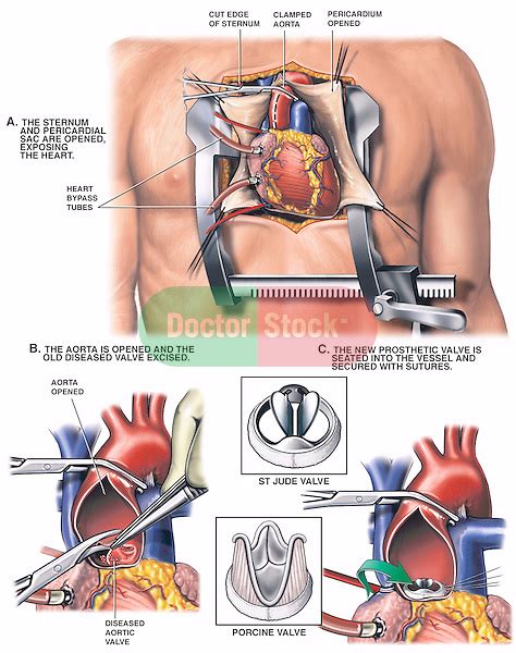 Aortic Valve Replacement Procedure | Doctor Stock