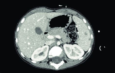 CT scan image in venous phase showing increased volume of the spleen ...