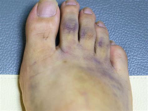 Purple feet: Causes and treatment