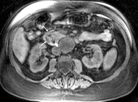 Annular Pancreas - The Operative Review Of Surgery