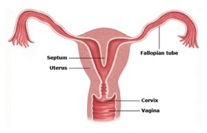 Uterine Septum Removal Found to Improve Fertility and Pregnancy Outcome - Austin Fertility ...