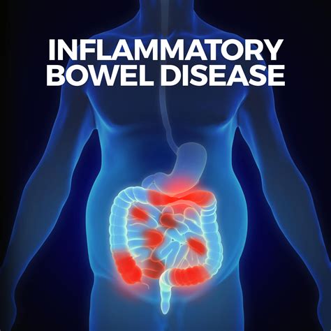 Inflammatory Bowel Disease Treatment | Gastro MD