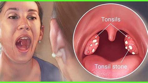 How To Diagnose Tonsillitis- Physical Examination For Tonsillitis - YouTube