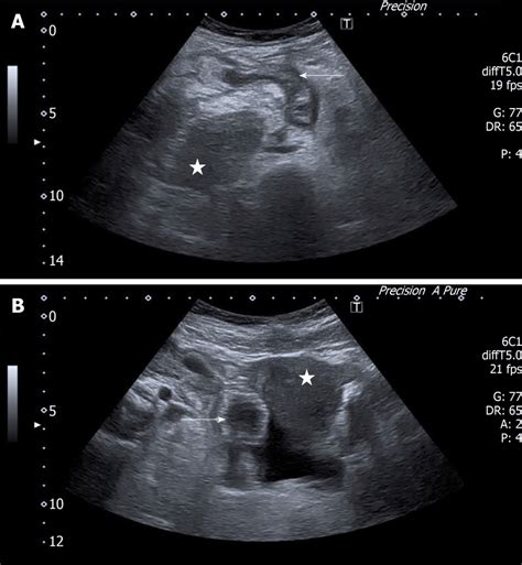 Ultrasound scan. A: A suspected inflamed appendix next to the uterine... | Download Scientific ...