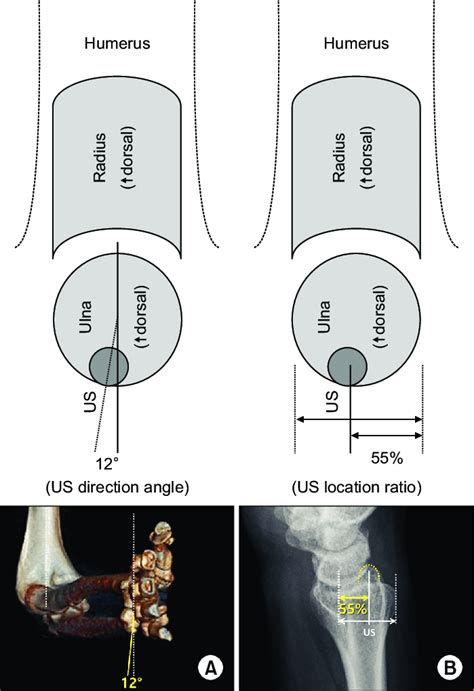 The absolute location of the ulnar styloid process on the axial plane... | Download Scientific ...