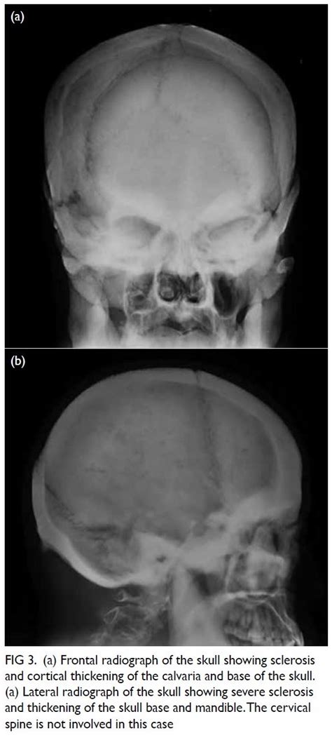 Craniodiaphyseal Dysplasia Skull