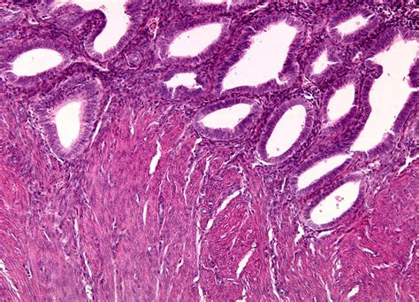 Adenomiosis Histology