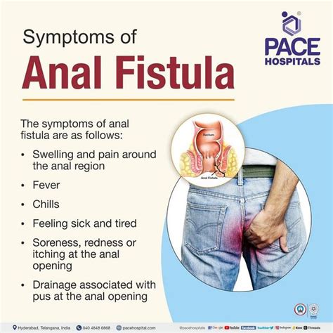 Fistula In Ano