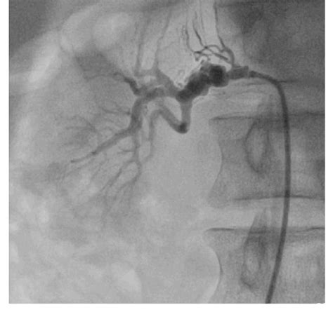 Right renal angiogram. | Download Scientific Diagram