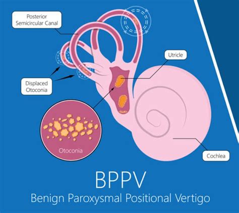 What is BPPV & How do you treat it? | Vertigo and Ear clinic