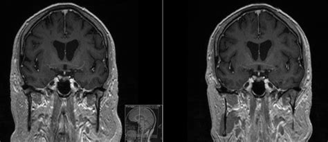 Radiology MRI: Anterior Commissure