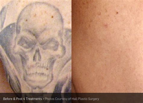 TATTOO REMOVAL - Rejuvenate Laser Center