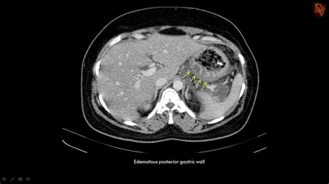 Ultimate Radiology : Acute Necrotizing Pancreatitis