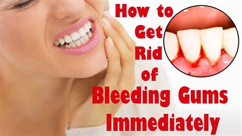 How to Get Rid of Bleeding Gums Immediately || Treat Your Bleeding Gums With This Home Remedy ...