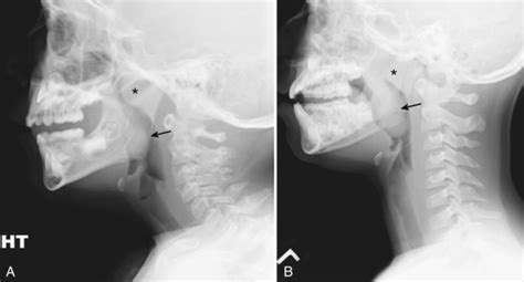 Adenoid Hypertrophy X Ray