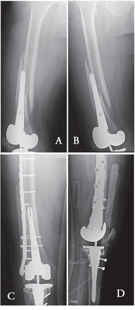 a, b) AP and Lateral x-rays showing a periprosthetic distal femur ...