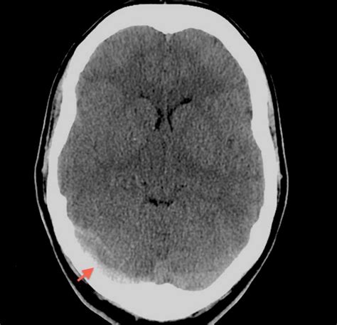 Dural sinus thrombosis and venous infarction | Radiology Case ...