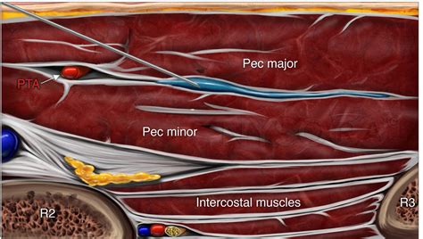 Pectoralis and Serratus Plane Nerve Blocks - NYSORA