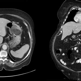 A CT scan of the abdomen showed a hypodense lesion measuring 6 × 6 ×... | Download Scientific ...