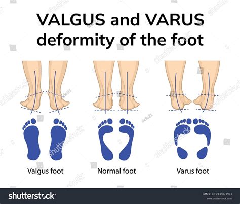 461 Varus Feet Images, Stock Photos, 3D objects, & Vectors | Shutterstock