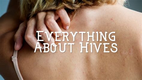 What Causes Hives and How to Treat Them - HubPages