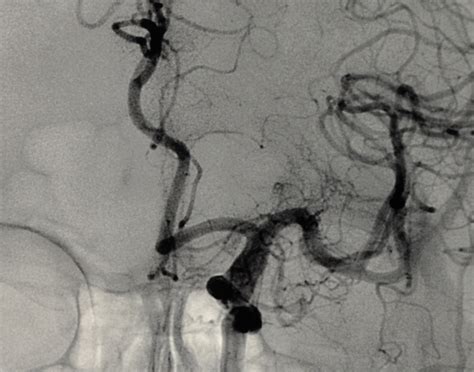 Cerebral angiography