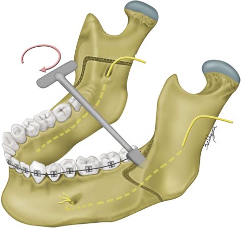 The outcome of skeletofacial reconstruction with mandibular rotation for management of ...