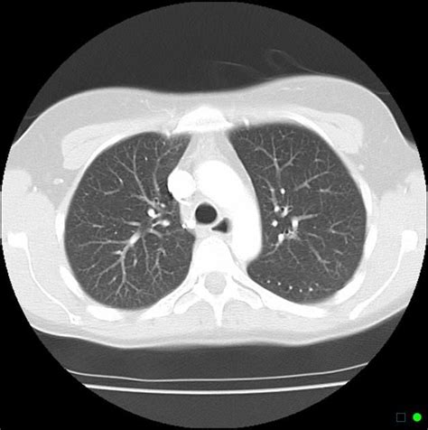 Normal chest CT (lung window) | Radiology Case | Radiopaedia.org | Chest, Radiology, Lunges