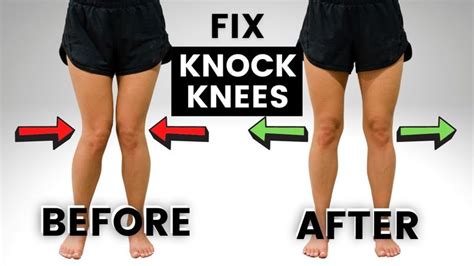 How to Fix KNOCK KNEES (without SURGERY!) | Knock knees, Knee exercises ...