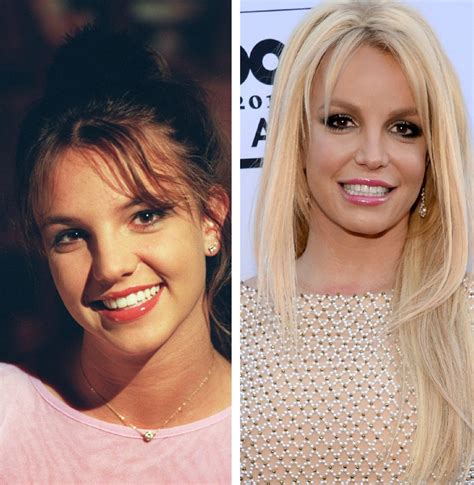 Britney Spears Before and After Cosmetic Surgery - Verge Campus