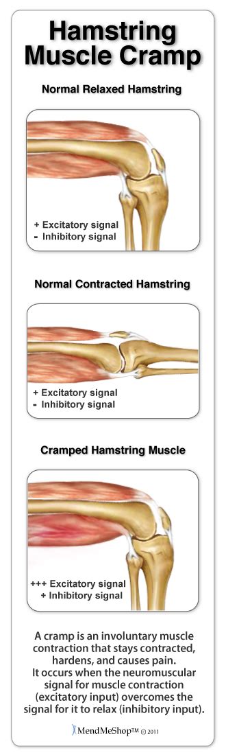 Hamstring Muscle Cramps